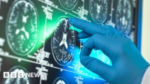 Alzheimer’s Drug Review Triggers Backlash as Benefit Debate Intensifies